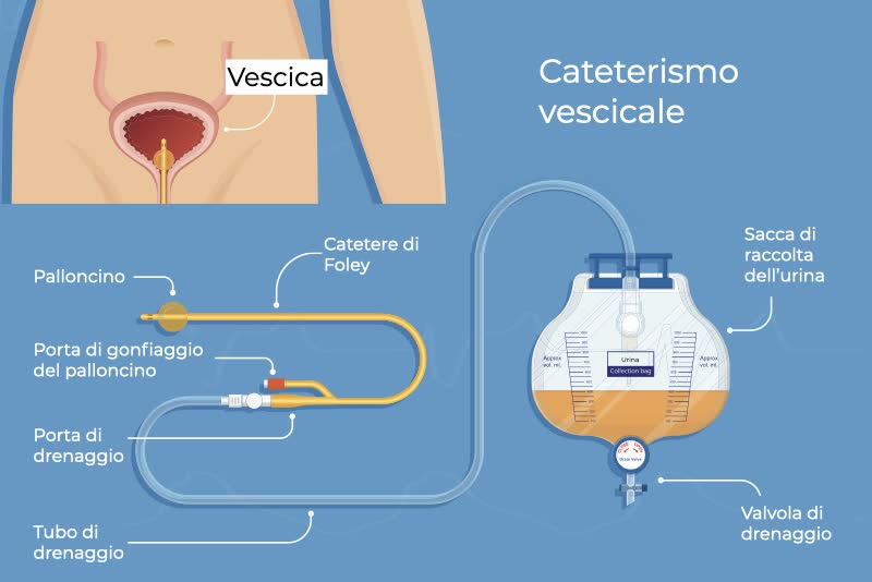 Applicazione Catetere Vescicale