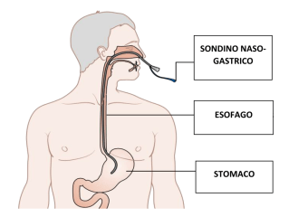 Applicazione Sondino Naso Gastrico
